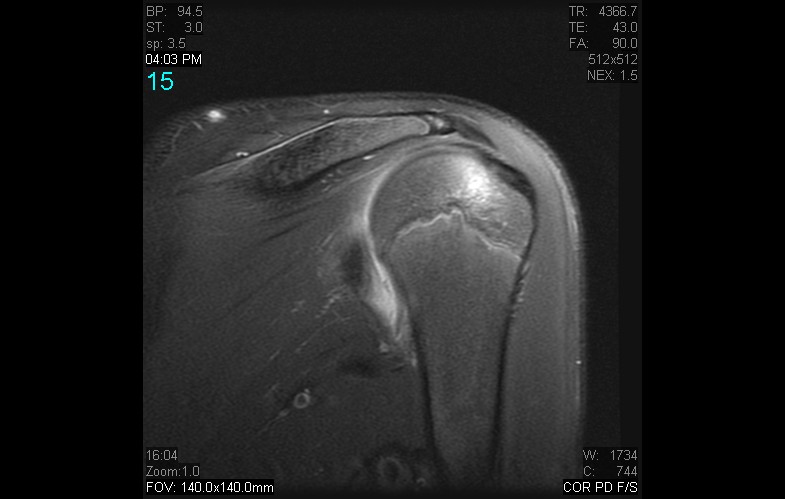 Figure 5 for case anterior shoulder dislocation